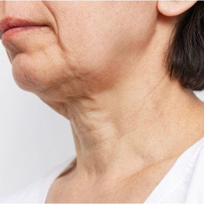 LARGE, SAGGING PORES